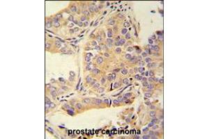 UBA52 antibody immunohistochemistry analysis in formalin fixed and paraffin embedded human prostate carcinoma followed by peroxidase conjugation of the secondary antibody and DAB staining. (UBA52 anticorps  (C-Term))