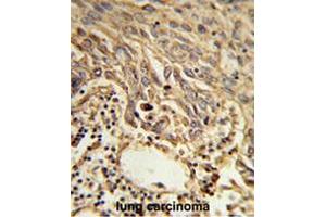 Formalin-fixed and paraffin-embedded human lung carcinoma reacted with EIF4A2 Antibody (C-term), which was peroxidase-conjugated to the secondary antibody, followed by DAB staining. (EIF4A2 anticorps  (C-Term))