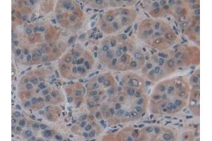 Detection of COL4a1 in Human Liver cancer Tissue using Polyclonal Antibody to Collagen Type IV Alpha 1 (COL4a1)