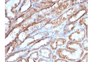 Formalin-fixed, paraffin-embedded human Renal Cell Carcinoma stained with Mitochondria Monoclonal Antibody (MTC719) (Mitochondrial Marker anticorps)