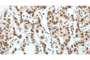 Immunohistochemistry of paraffin-embedded Human breast cancer using BNIP1 Polyclonal Antibody at dilution of 1:60 (BNIP1 anticorps)