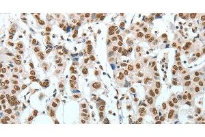 Immunohistochemistry of paraffin-embedded Human breast cancer using BNIP1 Polyclonal Antibody at dilution of 1:60