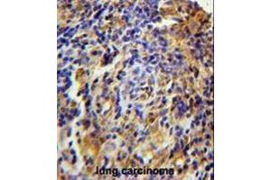 CK073 Antibody (N-term) immunohistochemistry analysis in formalin fixed and paraffin embedded human lung carcinoma followed by peroxidase conjugation of the secondary antibody and DAB staining. (C11orf73 anticorps  (N-Term))