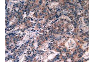 IHC-P analysis of Human Rectum Cancer Tissue, with DAB staining. (PDGFRA anticorps  (AA 170-387))