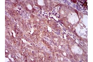 Immunohistochemical analysis of paraffin-embedded cervical cancer tissues using EGFR mutant mouse mAb with DAB staining. (EGFR Mutant (AA 693-893) anticorps)