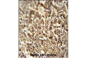 DIS3 antibody (Center) (ABIN654155 and ABIN2844022) immunohistochemistry analysis in formalin fixed and paraffin embedded human testis carcinoma followed by peroxidase conjugation of the secondary antibody and DAB staining. (DIS3 anticorps  (AA 295-323))