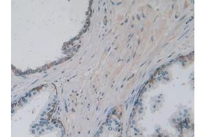 Detection of PKM2 in Human Prostate Tissue using Polyclonal Antibody to Pyruvate kinase isozymes M2 (PKM2)