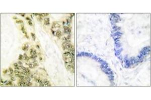 Immunohistochemistry analysis of paraffin-embedded human colon carcinoma tissue, using Thyroid Hormone Receptor alpha Antibody.