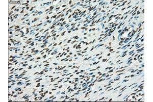 Immunohistochemical staining of paraffin-embedded Adenocarcinoma of breast tissue using anti-TYRO3 mouse monoclonal antibody. (TYRO3 anticorps)