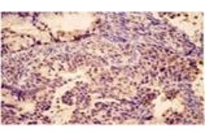 Immunohistochemistry analysis of human cervical cancer tissue with Bak pAb. (BAK1 anticorps)