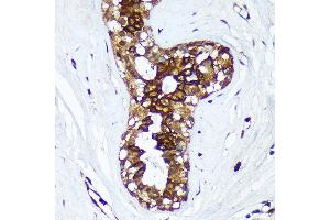 Immunohistochemistry of paraffin-embedded Human breast cancer using HSD17B7 Rabbit pAb (ABIN7267812) at dilution of 1:100 (40x lens). (HSD17B7 anticorps  (AA 110-200))