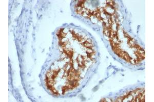 Formalin-fixed, paraffin-embedded human Testicular Carcinoma stained with Fascin-1 Mouse Monoclonal Antibody (FSCN1/417)