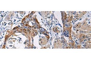 Immunohistochemistry of paraffin-embedded Human esophagus cancer tissue using RITA1 Polyclonal Antibody at dilution of 1:60(x200) (RITA1 anticorps)