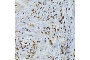 Immunohistochemistry of paraffin-embedded human gastric cancer using GABPB1 Antibody (ABIN2562720) at dilution of 1:100 (40x lens). (GABPB1 anticorps)