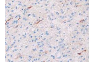 IHC-P analysis of Human Glioma Tissue, with DAB staining. (SLIT1 anticorps  (AA 647-835))