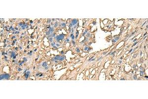 Immunohistochemistry of paraffin-embedded Human lung cancer tissue using CELA1 Polyclonal Antibody at dilution of 1:70(x200) (CELA1 anticorps)