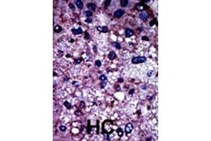 Formalin-fixed and paraffin-embedded human cancer tissue reacted with the primary antibody, which was peroxidase-conjugated to the secondary antibody, followed by DAB staining.
