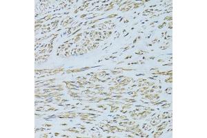 Immunohistochemistry of paraffin-embedded human uterine cancer using SLC40A1 antibody (ABIN6292414) at dilution of 1:100 (40x lens). (SLC40A1 anticorps)