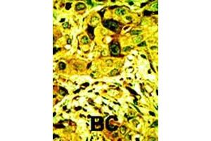 Formalin-fixed and paraffin-embedded human cancer tissue reacted with the primary antibody, which was peroxidase-conjugated to the secondary antibody, followed by AEC staining.