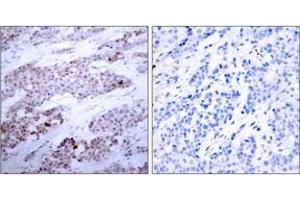 Immunohistochemistry analysis of paraffin-embedded human breast carcinoma, using ATF4 (Phospho-Ser245) Antibody.