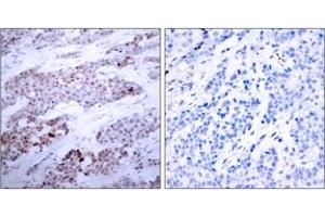 Immunohistochemistry analysis of paraffin-embedded human breast carcinoma, using ATF4 (Phospho-Ser245) Antibody. (ATF4 anticorps  (pSer245))