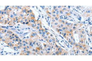 Immunohistochemistry of paraffin-embedded Human lung cancer using IMMT Polyclonal Antibody at dilution of 1:70 (IMMT anticorps)