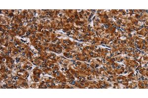 Immunohistochemistry of paraffin-embedded Human prostate cancer tissue using LRRC15 Polyclonal Antibody at dilution 1:60