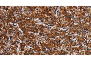 Immunohistochemistry of paraffin-embedded Human prostate cancer tissue using LRRC15 Polyclonal Antibody at dilution 1:60 (LRRC15 anticorps)