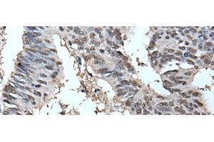 Immunohistochemistry of paraffin-embedded Human colorectal cancer tissue using HELLS Polyclonal Antibody at dilution of 1:30(x200) (HELLS anticorps)