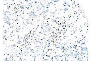 ABIN6260295 and ABIN6279783 at 1/100 staining Human liver cancer by IHC-P. (BMS1 anticorps  (C-Term))