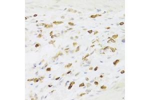 Immunohistochemistry of paraffin-embedded human gastric cancer using LSP1 Antibody (ABIN5973271) at dilution of 1/100 (40x lens). (LSP1 anticorps)