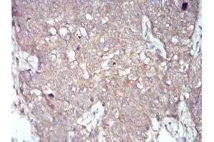 Immunohistochemical analysis of paraffin-embedded bladder cancer tissues using NOX4 mouse mAb with DAB staining. (NADPH Oxidase 4 anticorps  (AA 210-310))