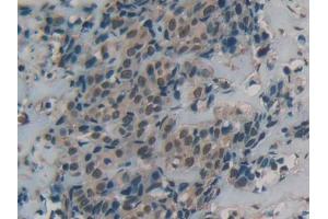 IHC-P analysis of Human Breast cancer Tissue, with DAB staining. (DBH anticorps  (AA 335-571))