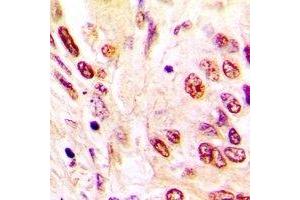 Immunohistochemical analysis of hNRNP C staining in human lung cancer formalin fixed paraffin embedded tissue section.