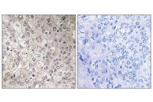 Immunohistochemistry analysis of paraffin-embedded human liver carcinoma tissue using GIPR antibody. (GIPR anticorps  (Internal Region))
