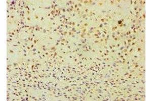 Immunohistochemistry of paraffin-embedded human breast cancer using ABIN7144295 at dilution of 1:100 (ANXA8L2 anticorps  (AA 1-276))