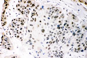 Anti- KAT3B/p300 Picoband antibody, IHC(P) IHC(P): Human Oesophagus Squama Cancer Tissue