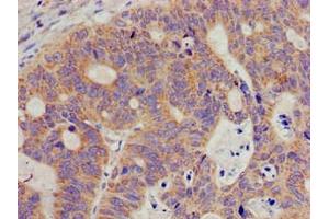 Immunohistochemistry of paraffin-embedded human colon cancer using ABIN7169599 at dilution of 1:100 (SIGMAR1 anticorps  (AA 112-169))