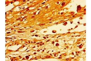 Immunohistochemistry of paraffin-embedded human melanoma using ABIN7171253 at dilution of 1:100