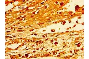 Immunohistochemistry of paraffin-embedded human melanoma using ABIN7171253 at dilution of 1:100 (STXBP1 anticorps  (AA 245-594))