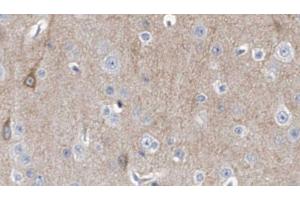 ABIN6278328 at 1/100 staining Human brain cancer tissue by IHC-P. (DCTN3 anticorps  (N-Term))