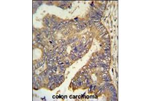 PAR6G Antibody IHC analysis in formalin fixed and paraffin embedded human colon carcinoma followed by peroxidase conjugation of the secondary antibody and DAB staining. (PARD6G anticorps  (N-Term))
