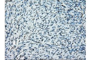 Immunohistochemical staining of paraffin-embedded Adenocarcinoma of breast tissue using anti-PRKY mouse monoclonal antibody. (PRKY anticorps)