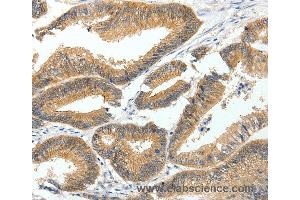 Immunohistochemistry of Human lung cancer using MDK Polyclonal Antibody at dilution of 1:60 (Midkine anticorps)
