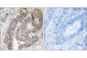 Immunohistochemistry analysis of paraffin-embedded human colon carcinoma, using CAD (Phospho-Thr456) Antibody. (CAD anticorps  (pThr456))