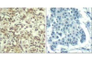 Immunohistochemical analysis of paraffin-embedded human breast carcinoma tissue using AKT1 (phospho- Thr450) Antibody (E011502). (AKT1 anticorps  (pThr450))