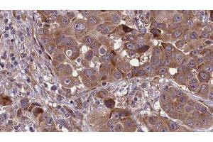 ABIN6277679 at 1/100 staining Human liver cancer tissue by IHC-P. (Serotonin Receptor 3A anticorps  (Internal Region))
