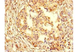 Immunohistochemistry of paraffin-embedded human pancreatic cancer using ABIN7164738 at dilution of 1:100 (PCNA anticorps  (AA 1-261))