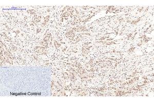 Immunohistochemical analysis of paraffin-embedded human breast cancer tissue. (PARP1 anticorps  (cleaved))
