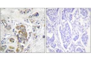 Immunohistochemistry analysis of paraffin-embedded human breast carcinoma, using ITGB4 (Phospho-Tyr1510) Antibody. (Integrin beta 4 anticorps  (pTyr1510))